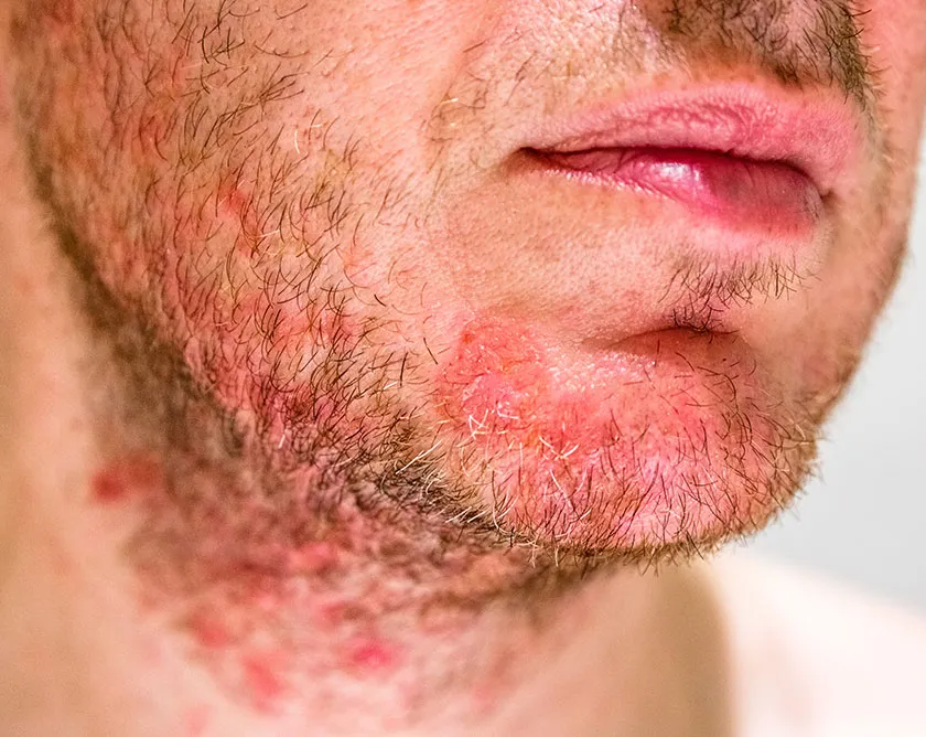 Diferença entre Foliculite Decalvante e Foliculite Dissecante: Guia Completo