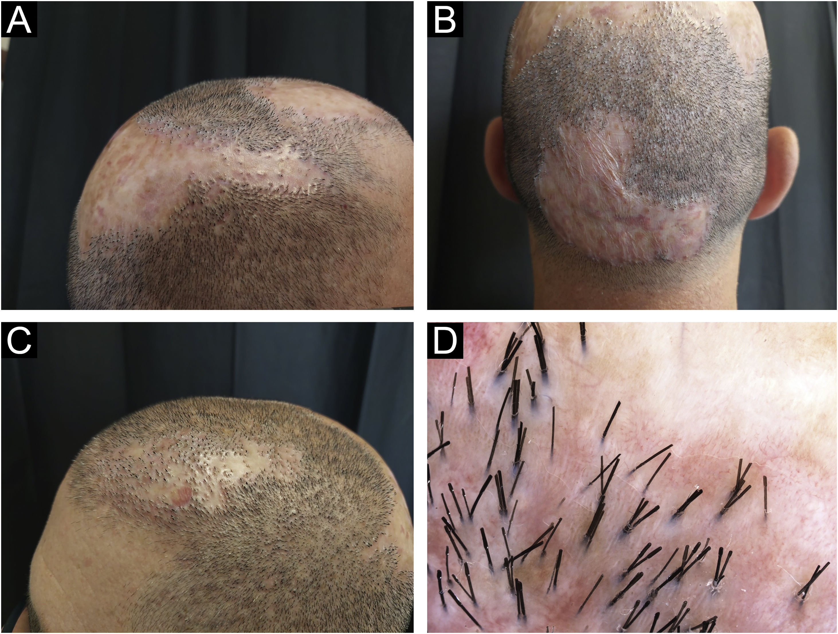 Guia de Tratamentos para Alopecia Cicatricial em São Paulo