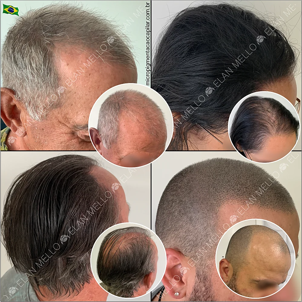 Especialista em microcapilar no Rio de Janeiro