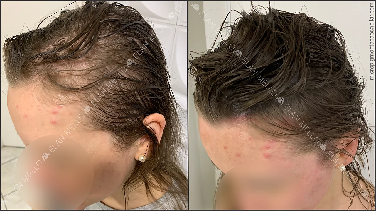 5 ideias de títulos:
1. Micropigmentação Capilar no Rio de Janeiro: Guia Completo dos Melhores Especialistas
2. Como a Micropigmentação Capilar Transforma a Aparência e a Autoestima
3. Entenda as Técnicas de Micropigmentação Capilar: Nano Pontos vs. 4D
4. Micropigmentação Capilar: O Que Esperar do Pós-Procedimento e Cuidados Essenciais
5. Especialistas em Micropigmentação Capilar: Onde Encontrar os Melhores no RJ