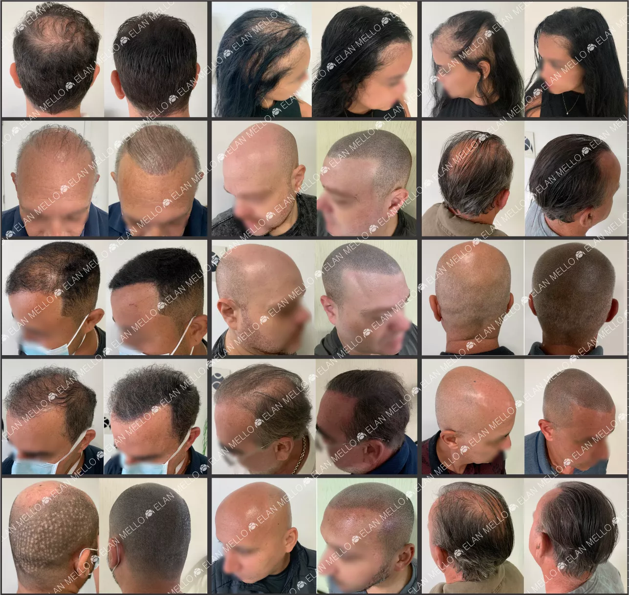 5 ideias de títulos:
1. Micropigmentação Capilar no Rio de Janeiro: Guia Completo dos Melhores Especialistas
2. Como a Micropigmentação Capilar Transforma a Aparência e a Autoestima
3. Entenda as Técnicas de Micropigmentação Capilar: Nano Pontos vs. 4D
4. Micropigmentação Capilar: O Que Esperar do Pós-Procedimento e Cuidados Essenciais
5. Especialistas em Micropigmentação Capilar: Onde Encontrar os Melhores no RJ