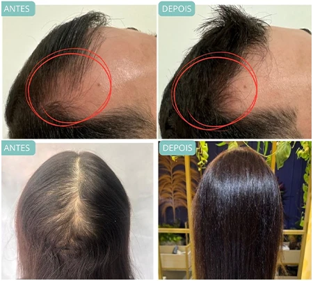 Dermatologistas Especialistas em Cabelo em Sorocaba: Conheça as Opções