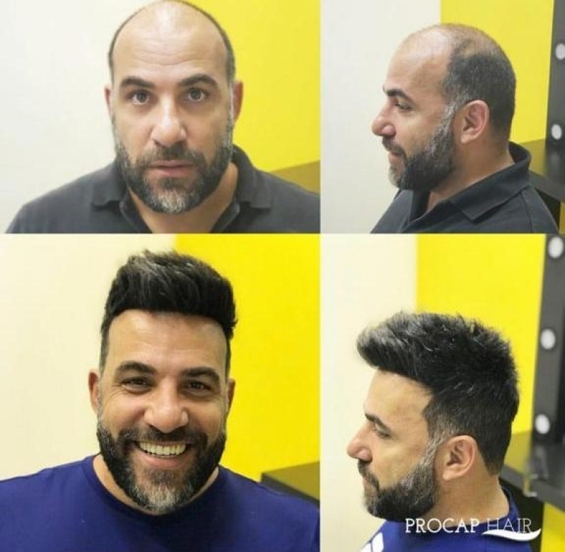 Treinamento e Suporte Técnico em Próteses Capilares: O Que Procurar em um Fornecedor