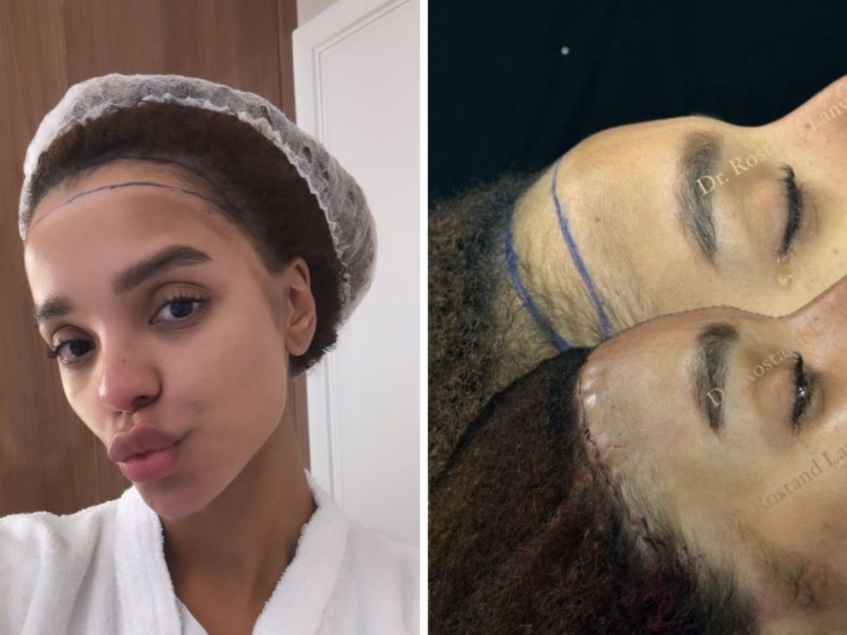 Desvendando os Custos: O que Inclui o Preço da Frontoplastia e Transplante Capilar?