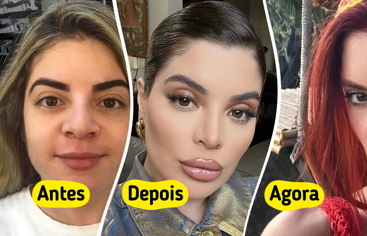 Síndrome do Rosto Inflado