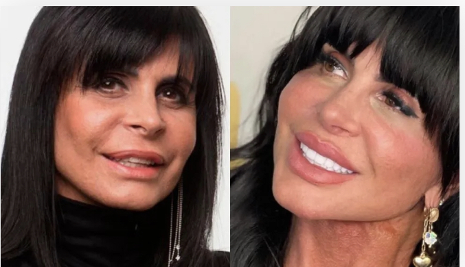 Excesso de preenchimento facial
