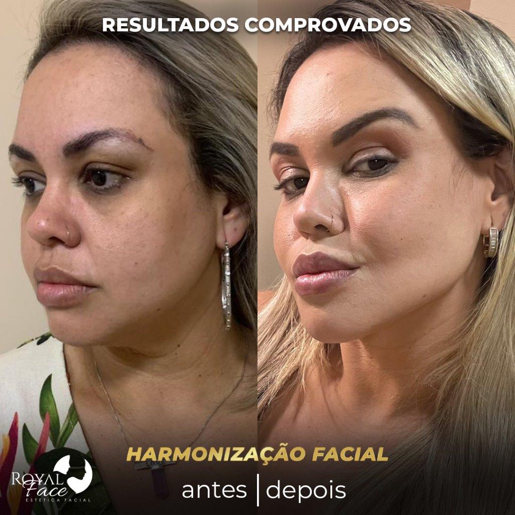 Consequências preenchimento facial excessivo