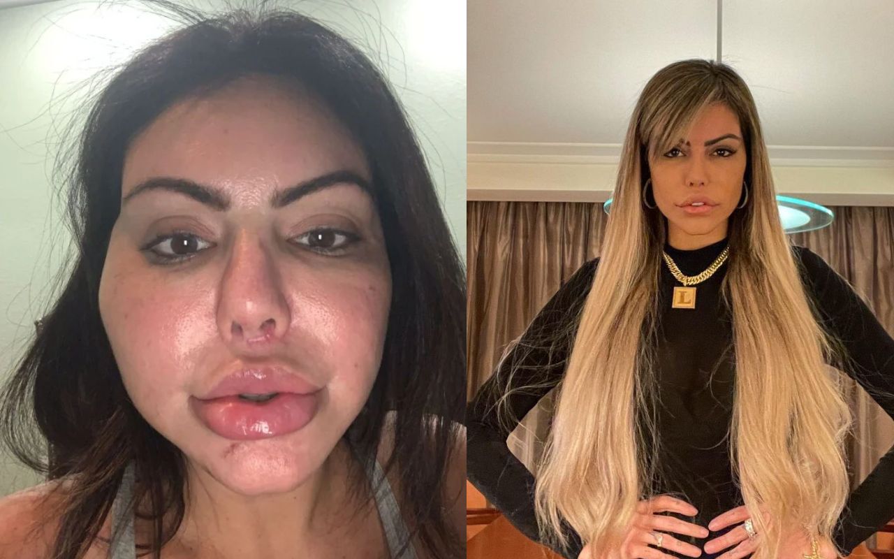 Como evitar exageros harmonização facial