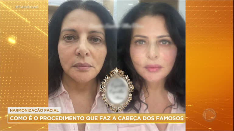Distúrbios de imagem e harmonização facial