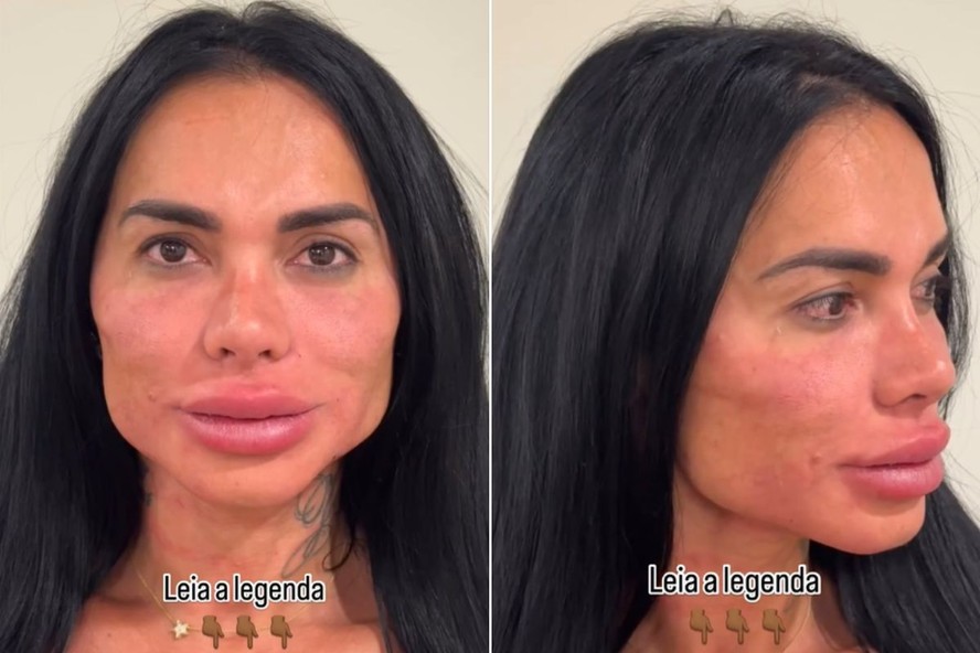 Riscos da harmonização facial