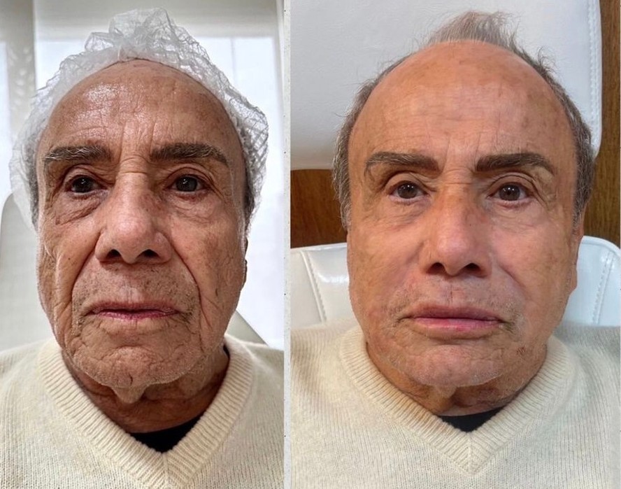 Famosos harmonização facial exagerada