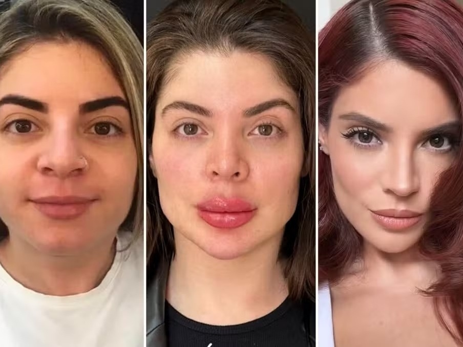 Como evitar exageros harmonização facial