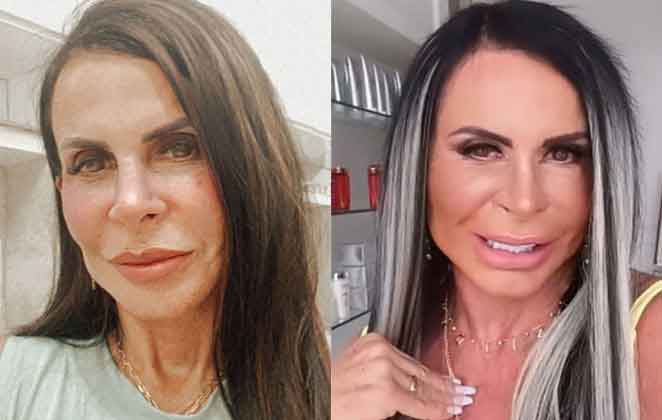 Distúrbios de imagem e harmonização facial
