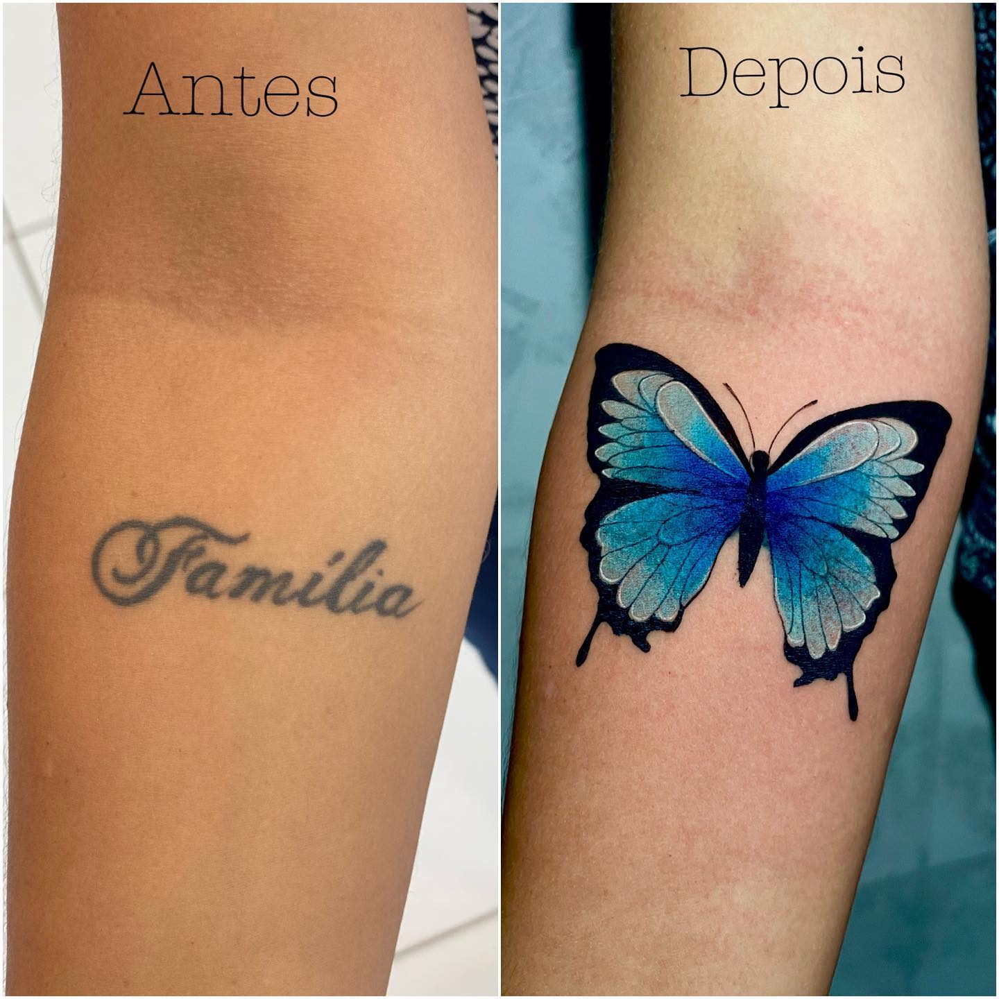 cover up ou remoção a laser qual melhor