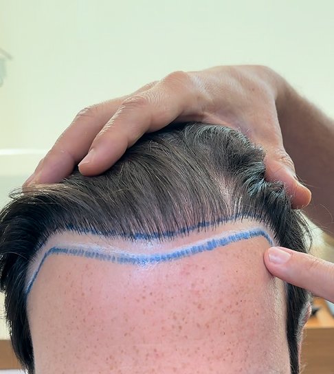 Transplante Capilar Mal Sucedido: Quais Seus Direitos?