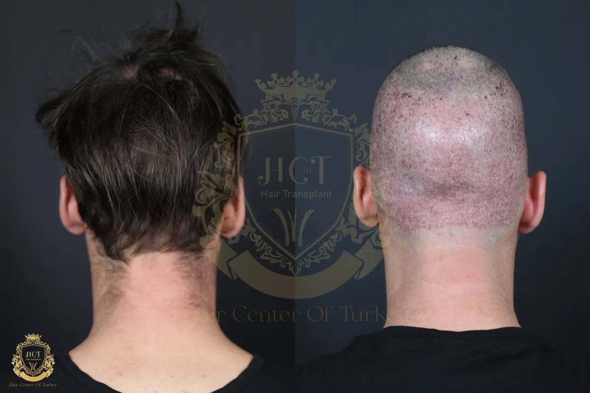 Guia Completo: Buscando Reparação por Erro em Transplante Capilar