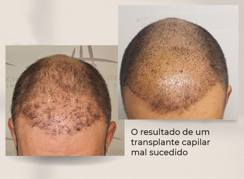 Indenização por transplante capilar mal sucedido