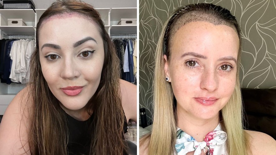 Como Provar Erro Médico em Transplante Capilar?