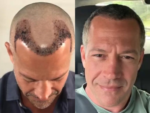 Danos Morais e Estéticos Após Implante Capilar: Entenda a Indenização