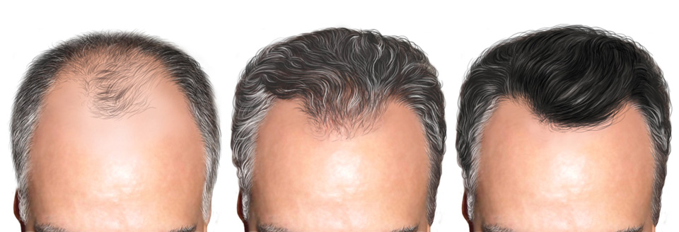 O Que Fazer Quando o Transplante Capilar Não Dá Certo?