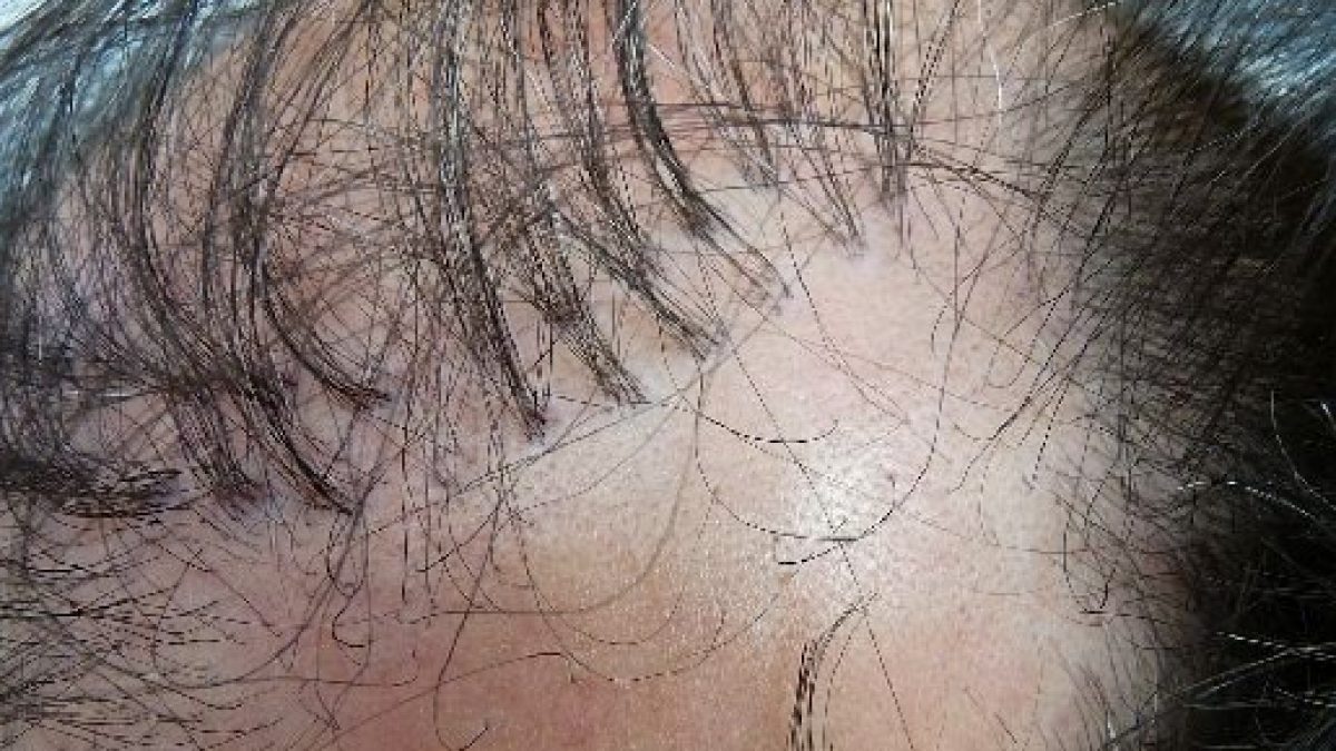 Indenização por transplante capilar mal sucedido