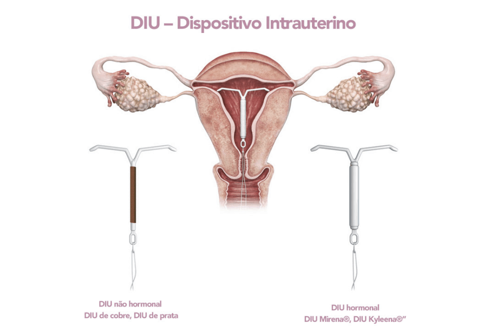melhores metodos contraceptivos para mulheres