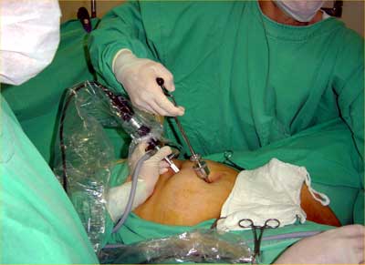 melhores métodos contraceptivos permanentes para mulheres