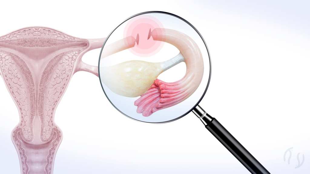 o que fazer se engravidar depois da laqueadura