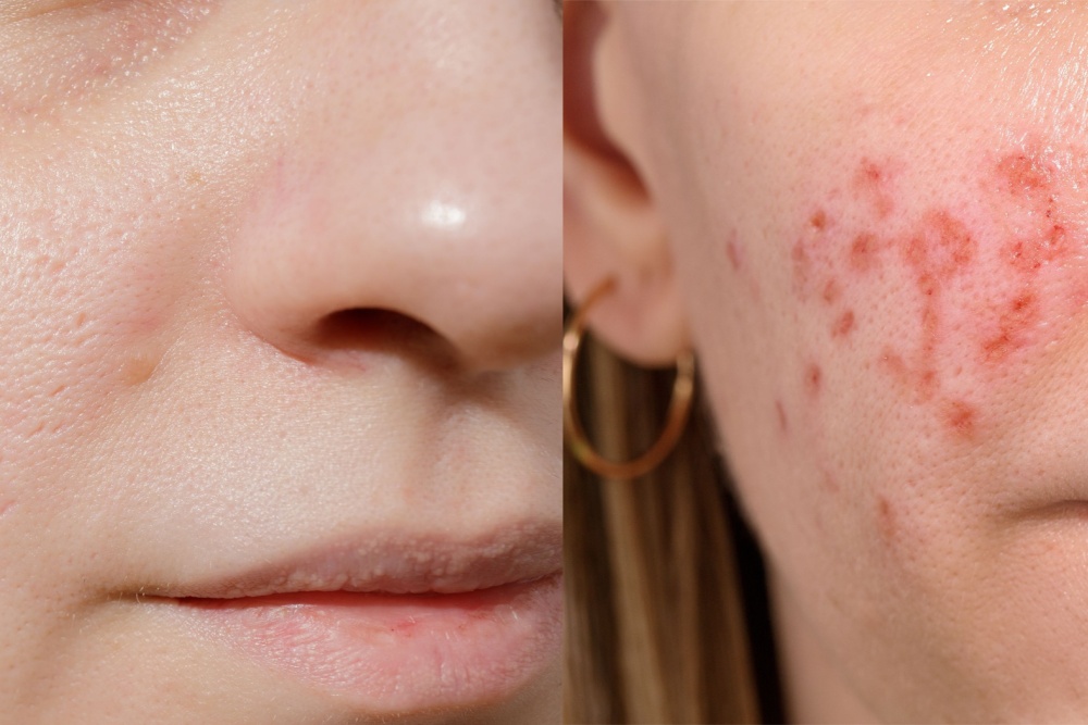 Laser Erbium Antes E Depois