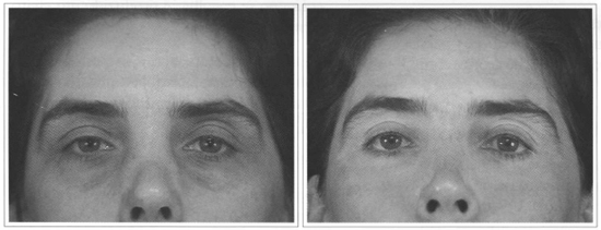 Laser Erbium Antes E Depois