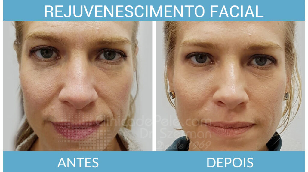 Laser Erbium Antes E Depois
