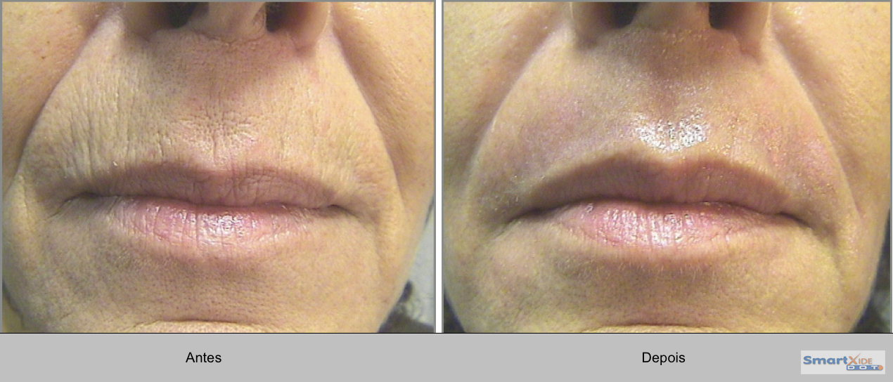 Laser Erbium Antes E Depois