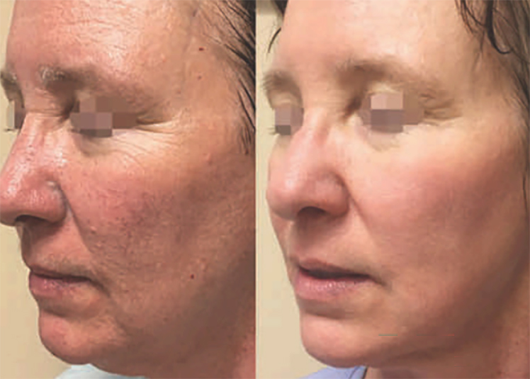 Laser Erbium Antes E Depois