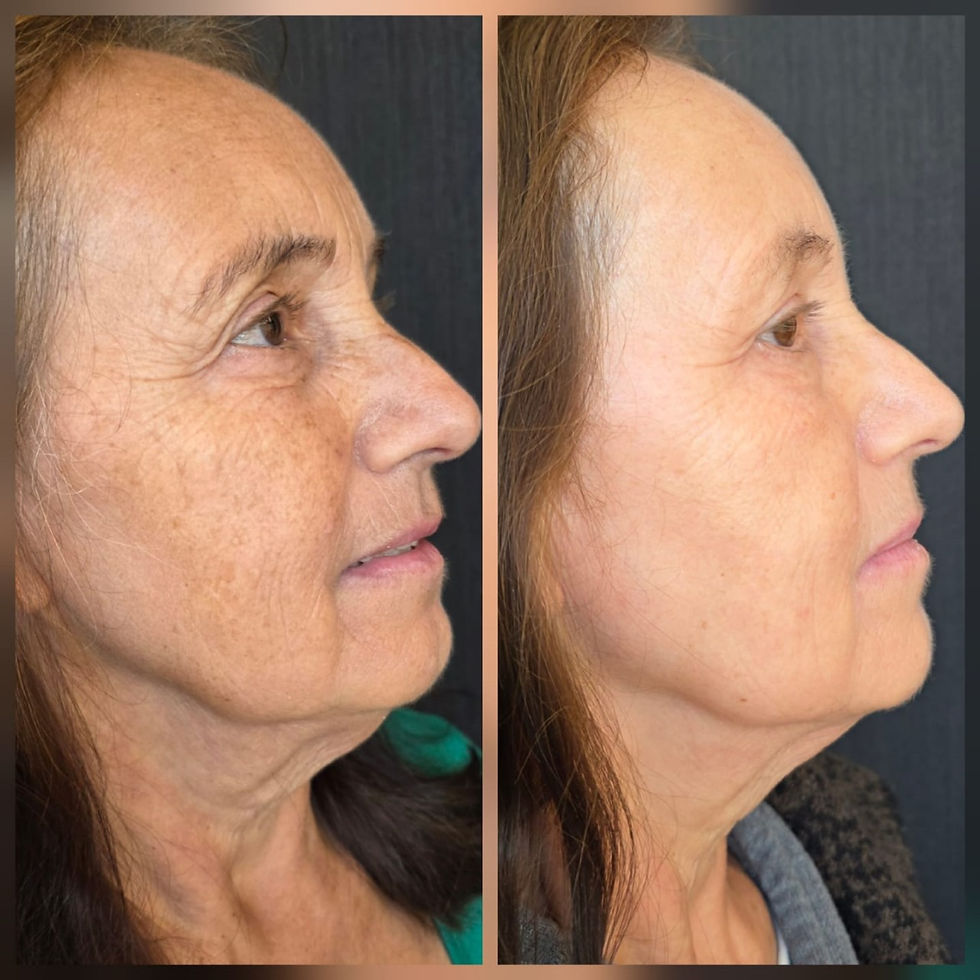 Laser Erbium Antes E Depois