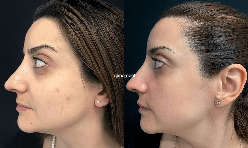 Laser Erbium Antes E Depois