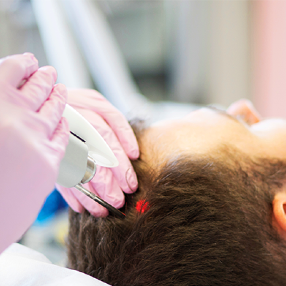 Microagulhamento e Laser Capilar: A Combinação Perfeita para Seus Fios?