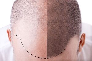 Prevenção e Opções de Tratamento