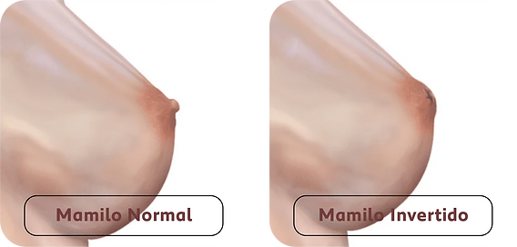 melhores dicas para amamentar com mamilo invertido