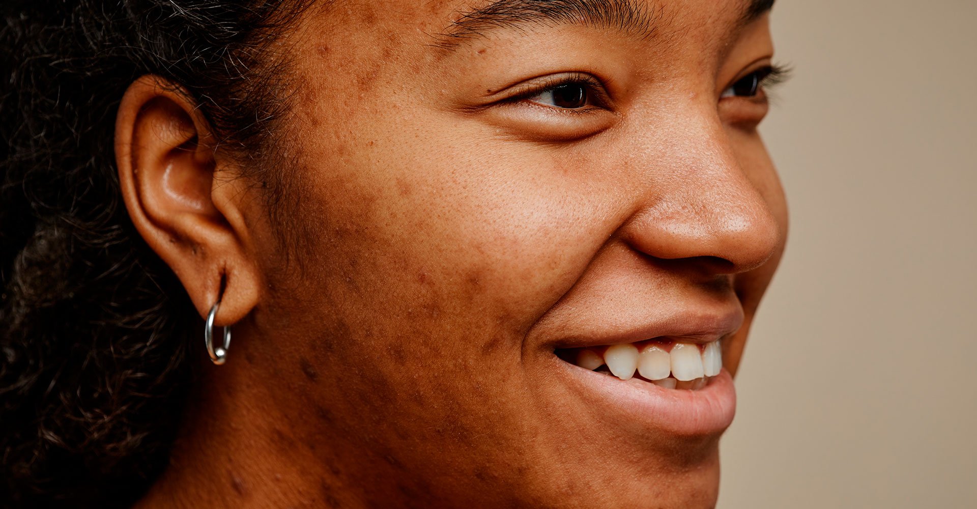 Guia Completo: Como Tratar Melasma na Pele Negra