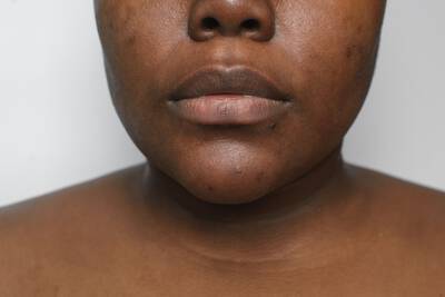 Acne na Pele Negra: Causas, Tratamentos e Prevenção de Manchas