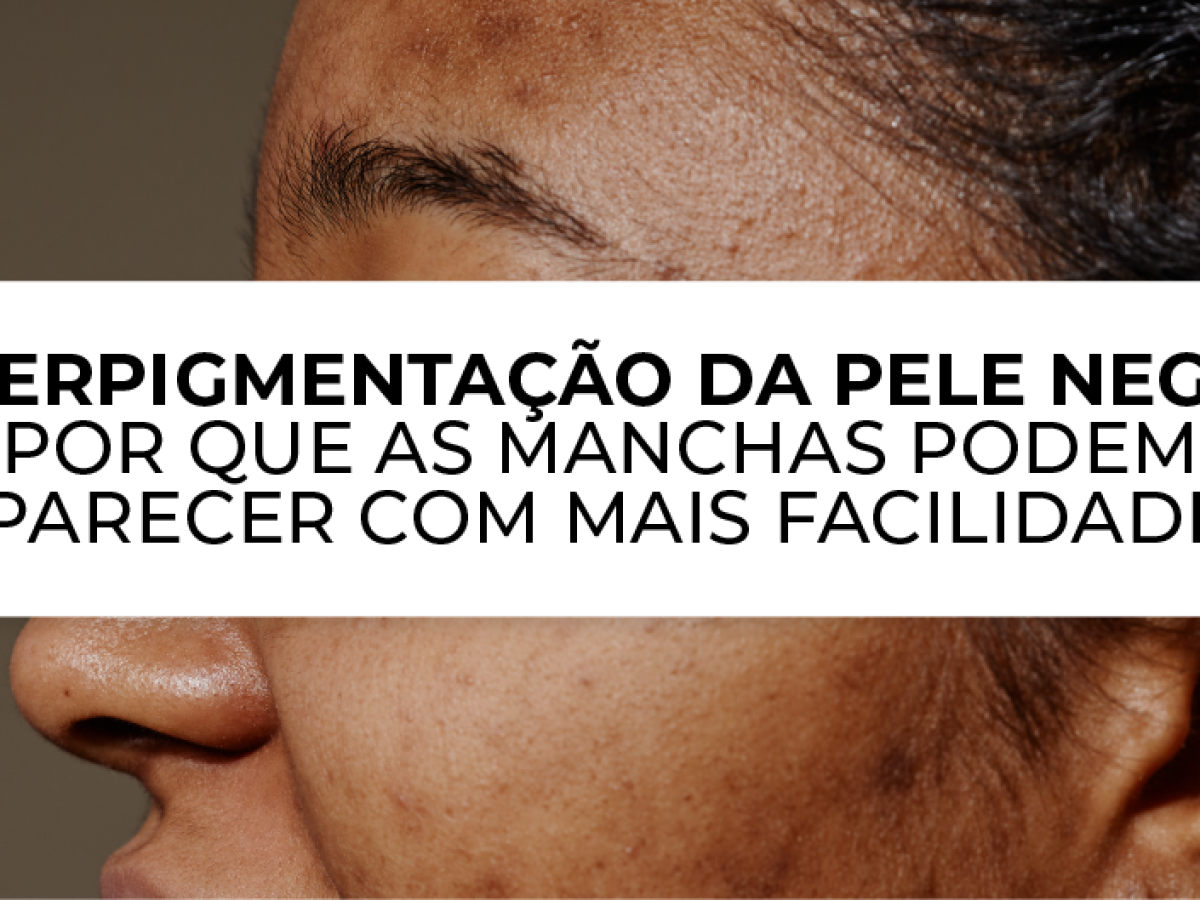 Manchas Na Pele Negra
