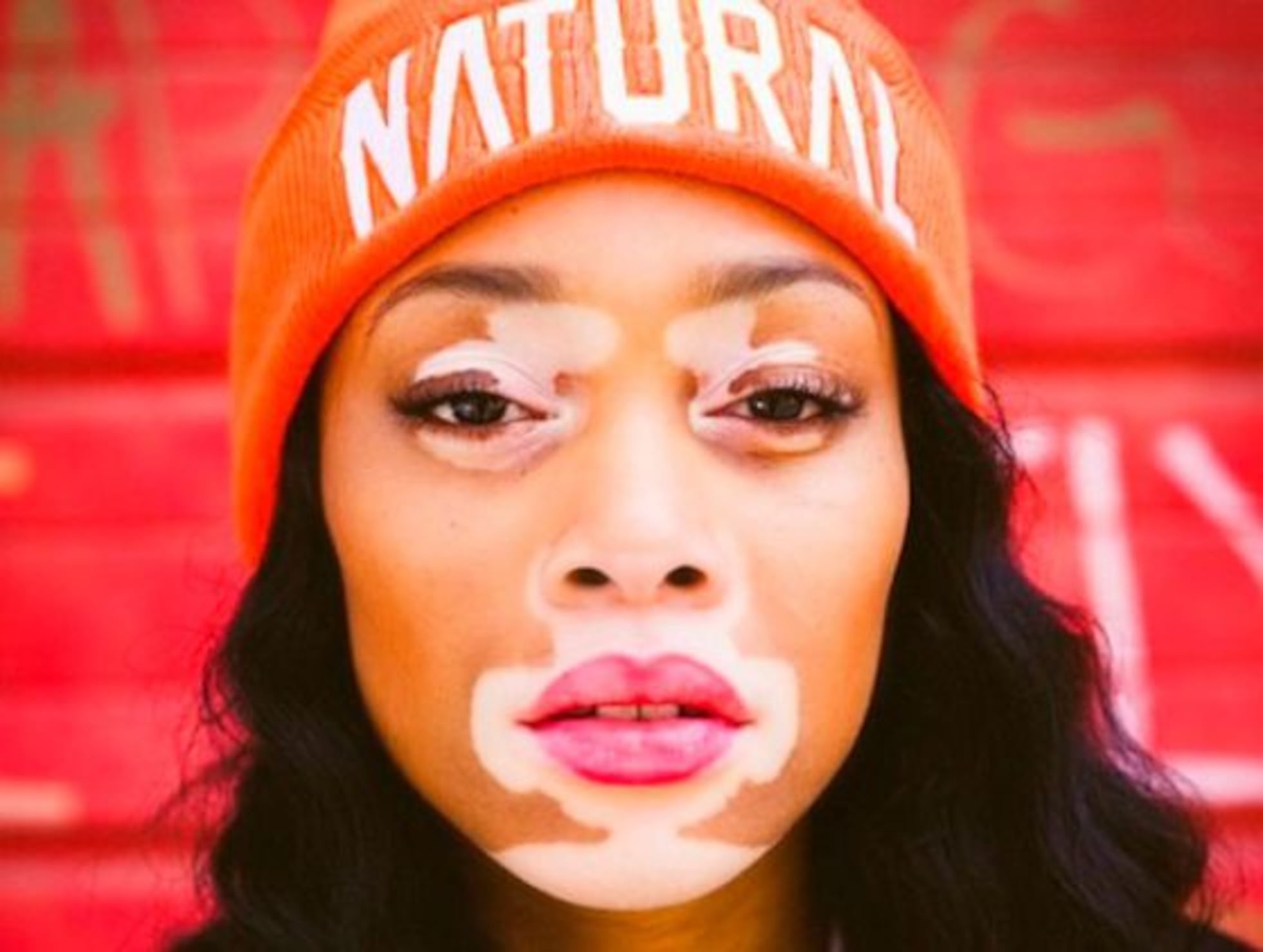 Vitiligo em Pele Negra: Entendendo as Causas e Opções de Tratamento