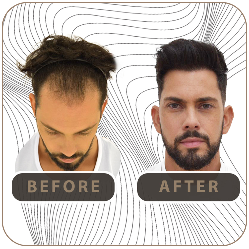 Melhor clínica de transplante capilar Istambul