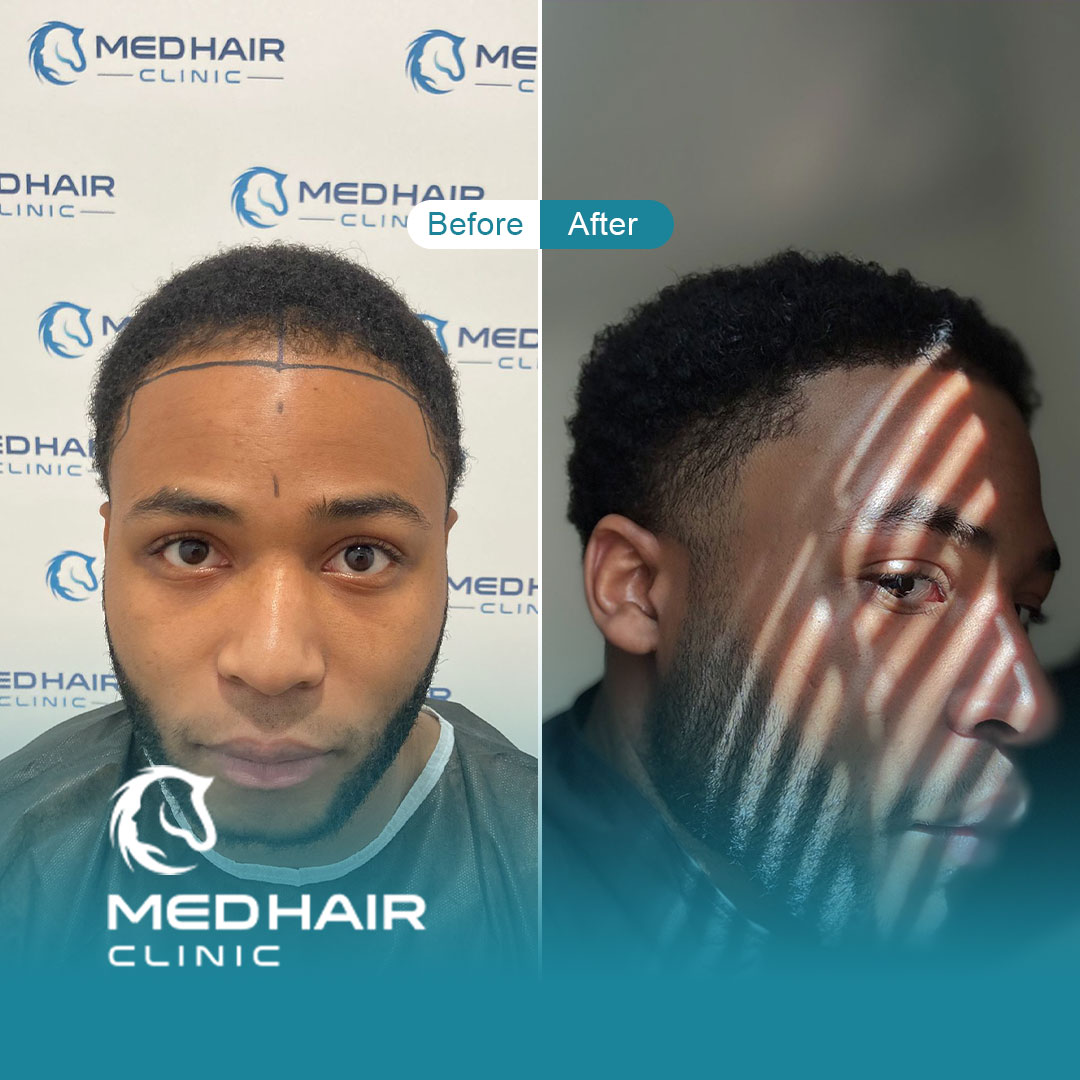 Guia Completo: Como Escolher a Melhor Clínica de Transplante Capilar em Istambul