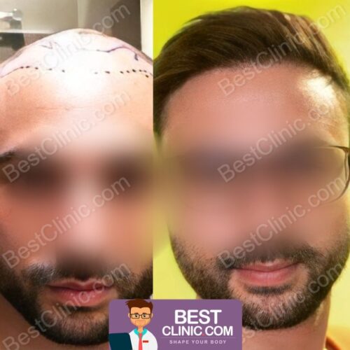 FUE Sapphire vs. DHI: Qual Técnica de Transplante Capilar é Ideal para Você?