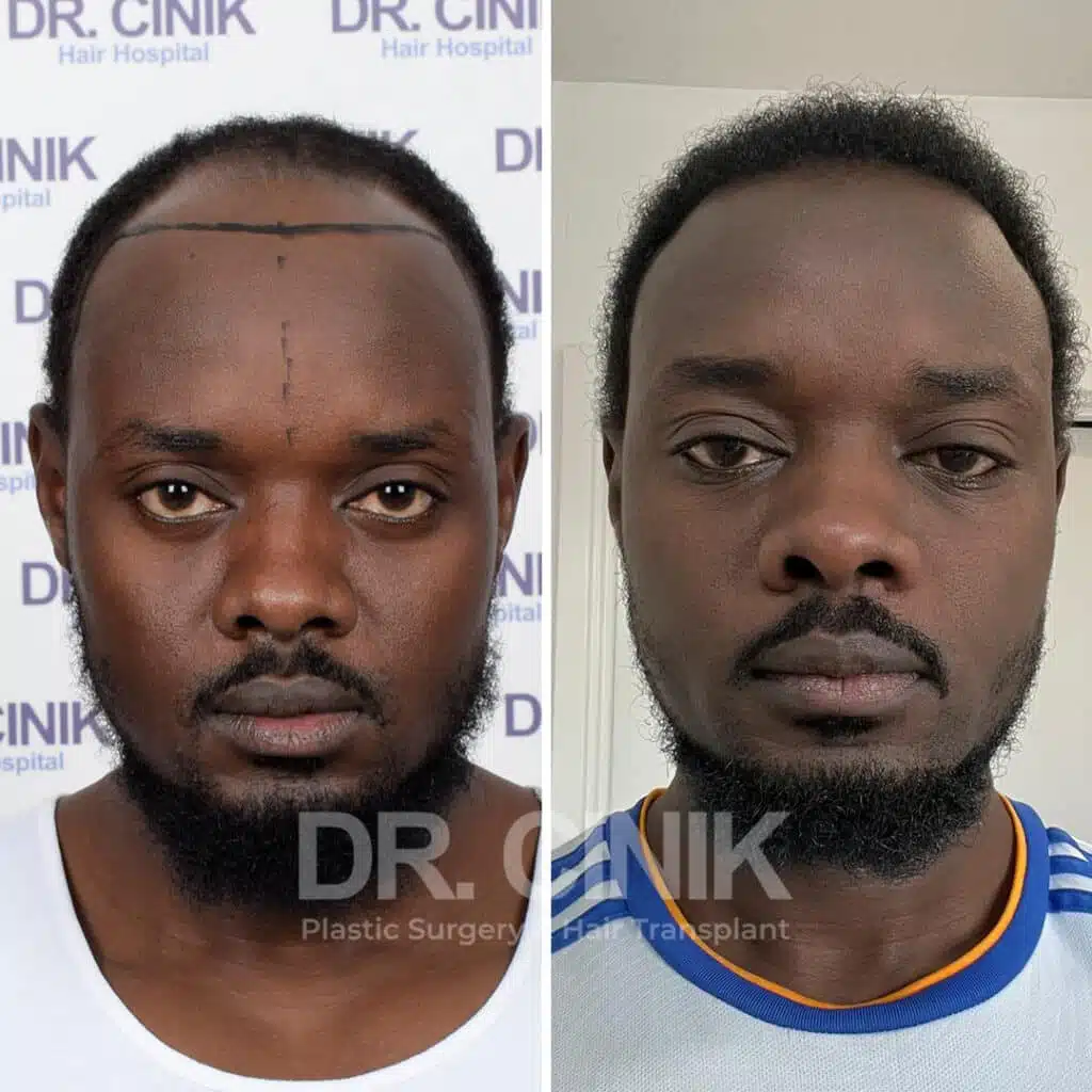 Depoimentos Reais: Pacientes Brasileiros Compartilham suas Experiências de Transplante Capilar na Turquia