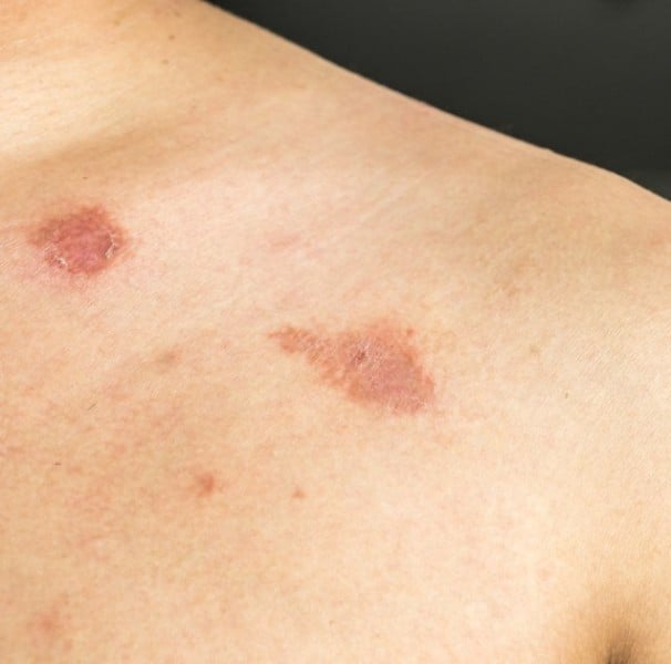 micose na pele como tratar