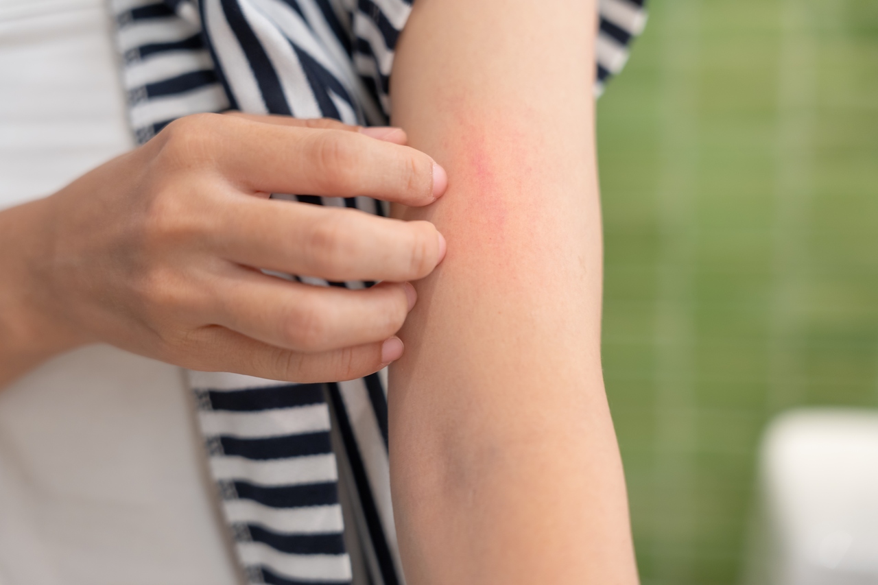 micose na pele como tratar