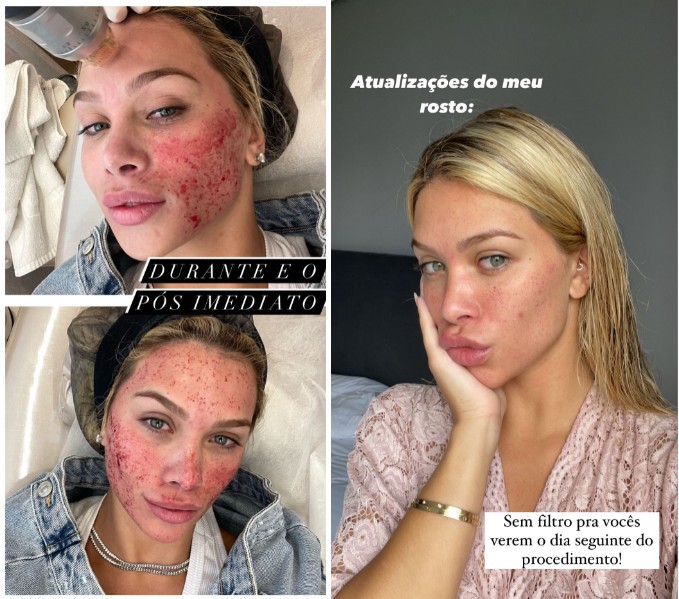 ácidos e retinol pós microagulhamento