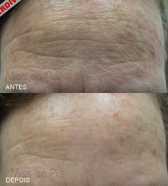 microagulhamento melasma cuidados